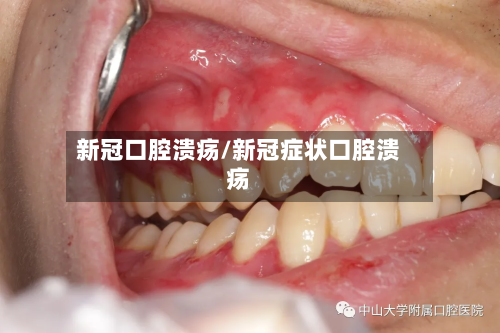 新冠口腔溃疡/新冠症状口腔溃疡