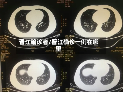 晋江确诊者/晋江确诊一例在哪里-第2张图片
